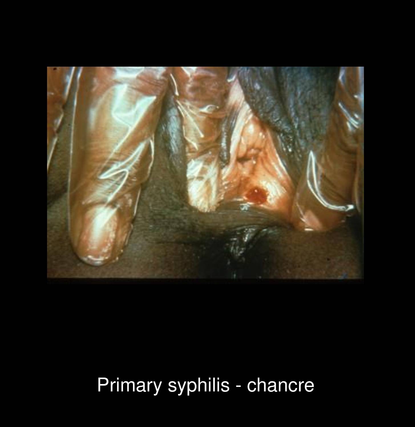 Secondary syphilis rash on soles showing hyperpigmented papulosquamous lesions with desquamation caused by Treponema pallidum dissemination